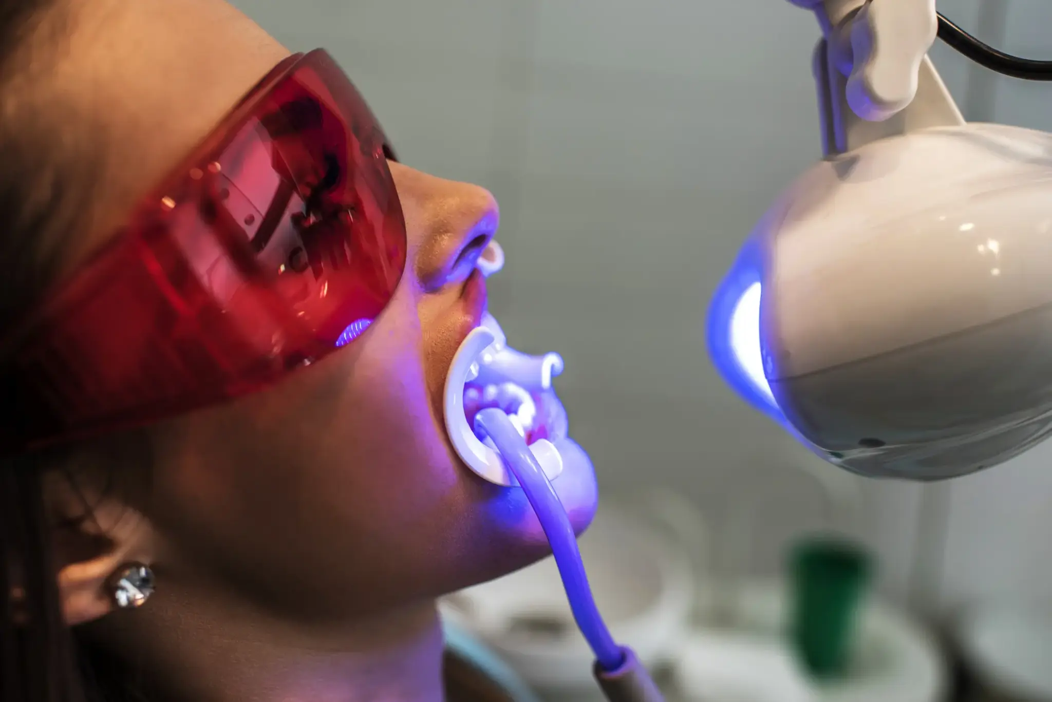 Bleaching | Frau mit Schutzbrille bei professioneller Zahnaufhellung (Bleaching) in der Zahnarztpraxis – Anwendung mit Speziallampe.