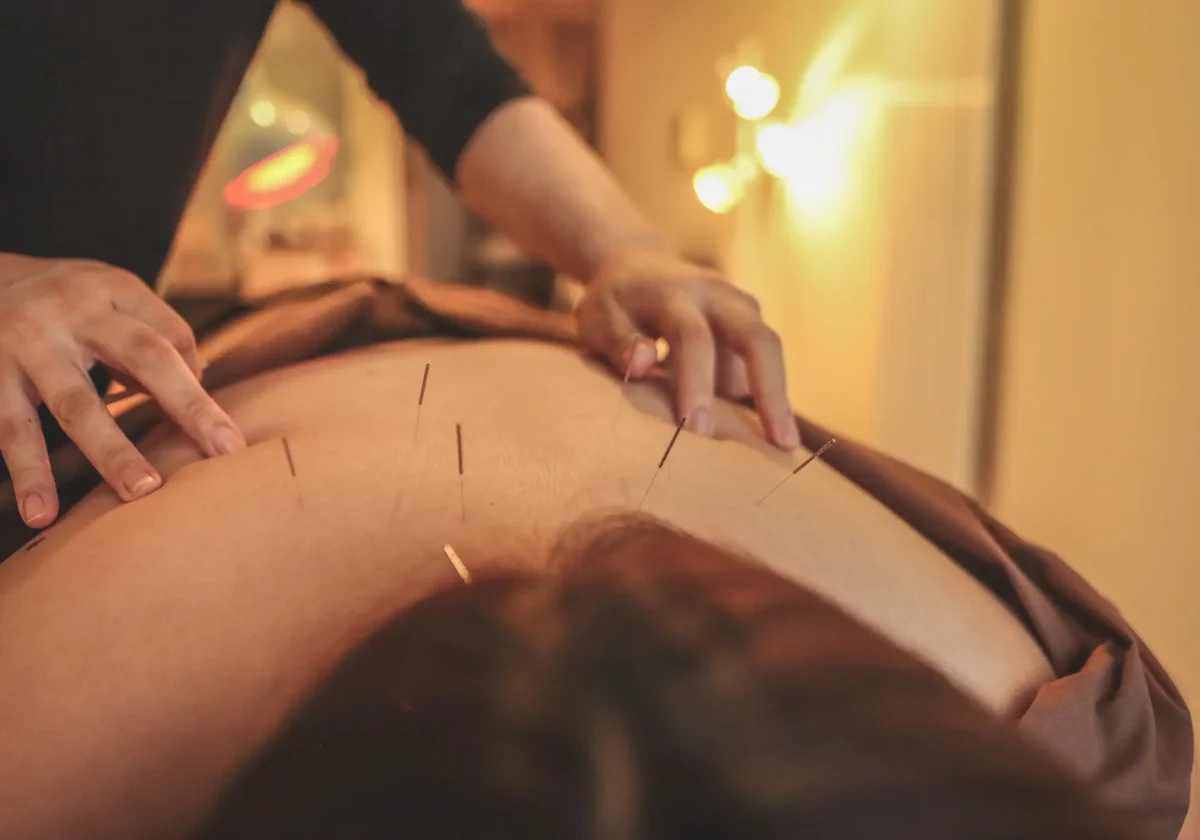 Therapeut führt Akupunktur an einem Rücken durch – alternativmedizinische Behandlung wie im Hufelandverzeichnis gelistet
