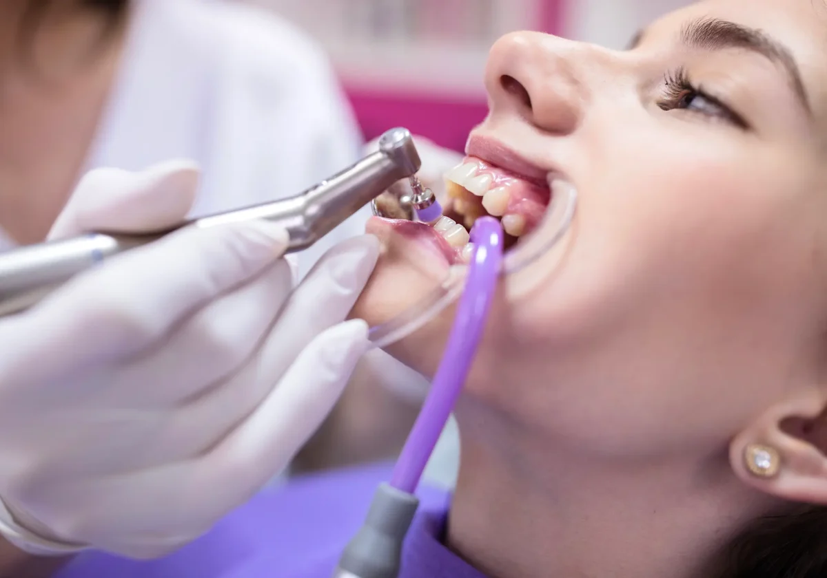 Frau bei professioneller Zahnreinigung – Zahnarzt oder Prophylaxe-Fachkraft reinigt Zähne mit Spezialinstrument in Zahnarztpraxis.
